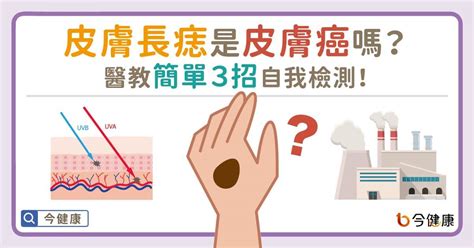 臉頰長痣|皮膚長痣是皮膚癌嗎？常見症狀，簡單3招自我檢測｜元氣